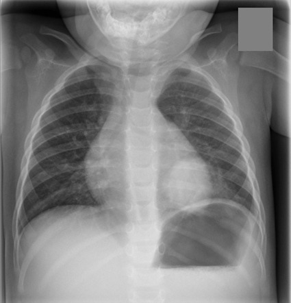 Round pneumonia | Radiology Case | Radiopaedia.org