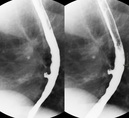 Esophageal Diverticulum