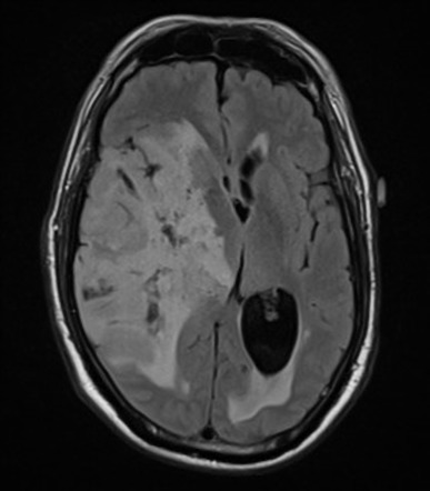 Anaplastic oligodendroglioma | Radiology Reference Article ...