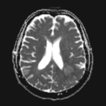 Glioblastoma IDH wild-type | Image | Radiopaedia.org