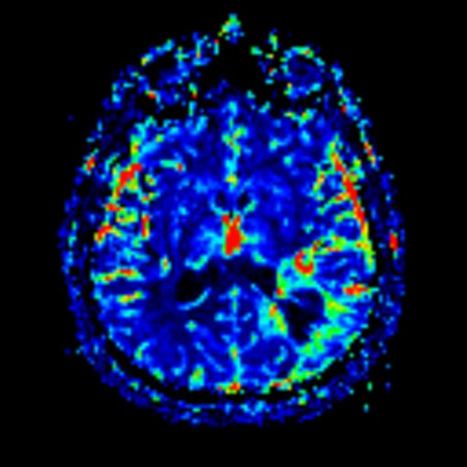 Glioblastoma IDH wild-type | Image | Radiopaedia.org