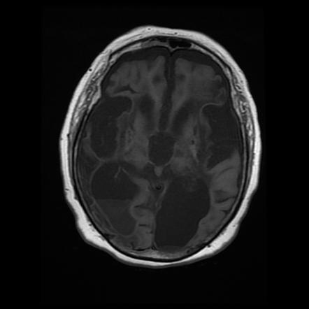 Brain abscess with ventriculitis | Image | Radiopaedia.org