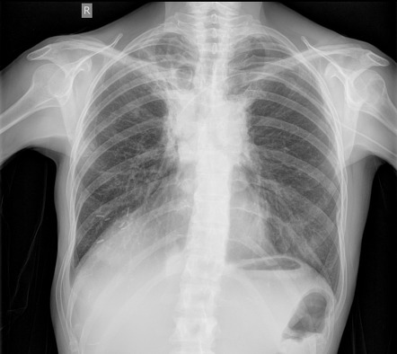 Radiation pneumonitis | Image | Radiopaedia.org