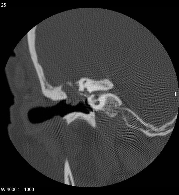 Cholesteatoma | Radiology Reference Article | Radiopaedia.org