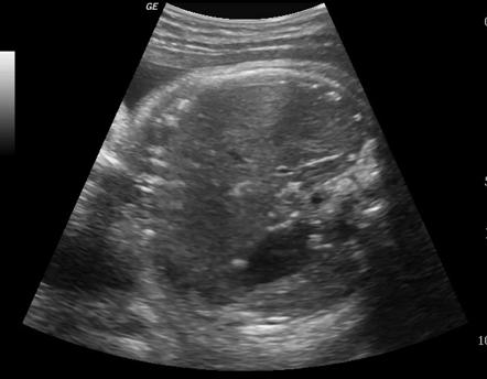 Meconium peritonitis | Radiology Case | Radiopaedia.org