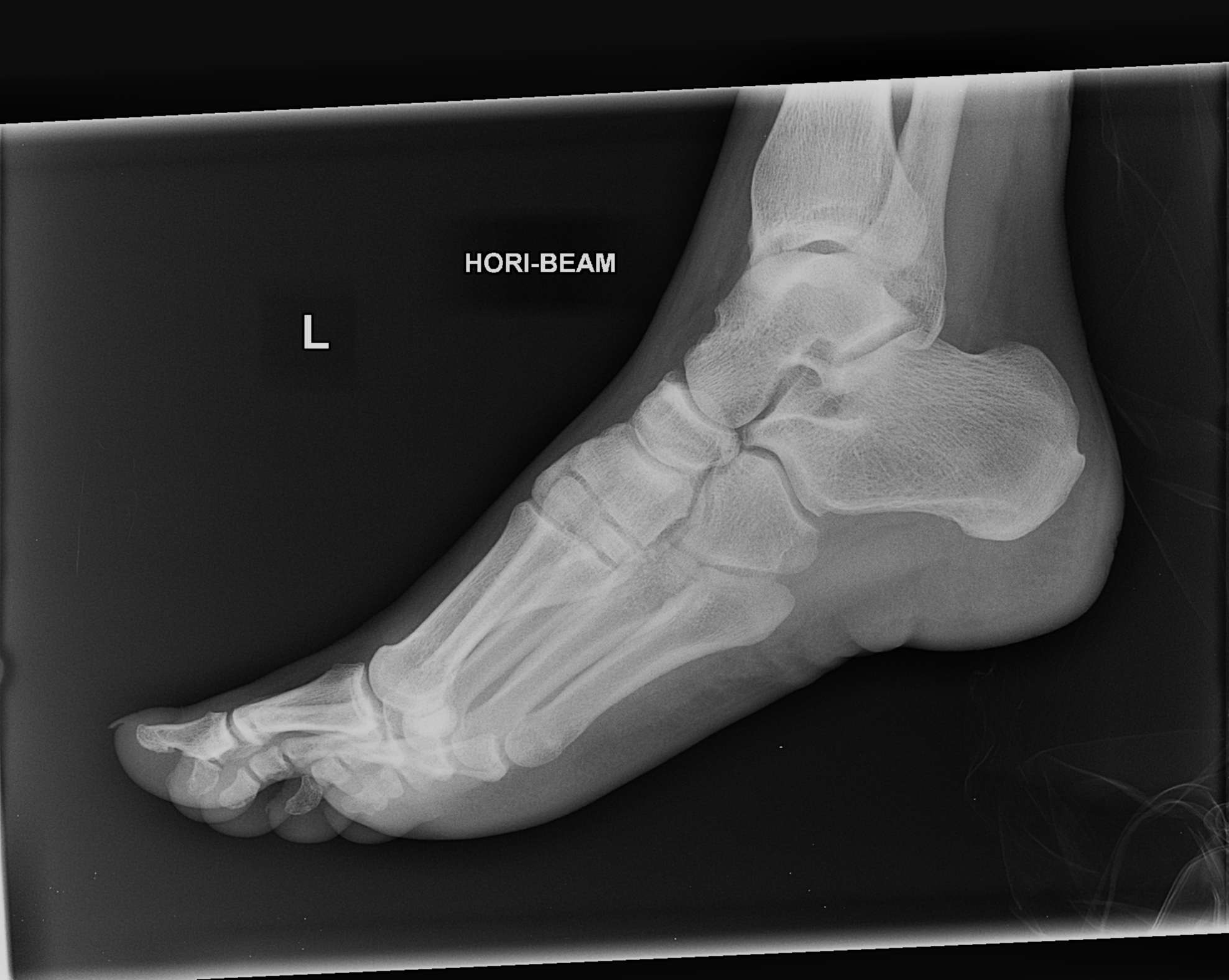 Calcaneus. Рентгенограмма пяточной кости. Пяточный бурсит рентген.