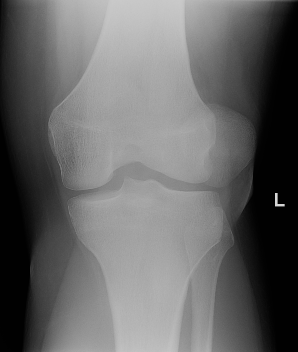 Lateral Patellar Dislocation 