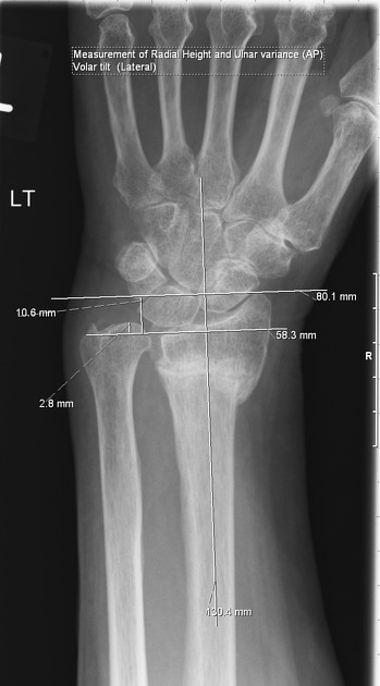 broken radius x ray