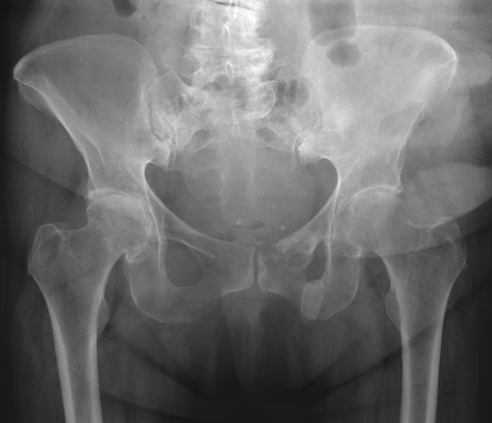 Myositis ossificans | Radiology Reference Article | Radiopaedia.org