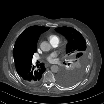 Iatrogenic diaphragm rupture | Radiology Case | Radiopaedia.org