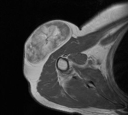 Liposarcoma Vs Lipoma