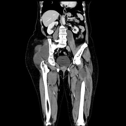 Mazabraud syndrome | Radiology Case | Radiopaedia.org