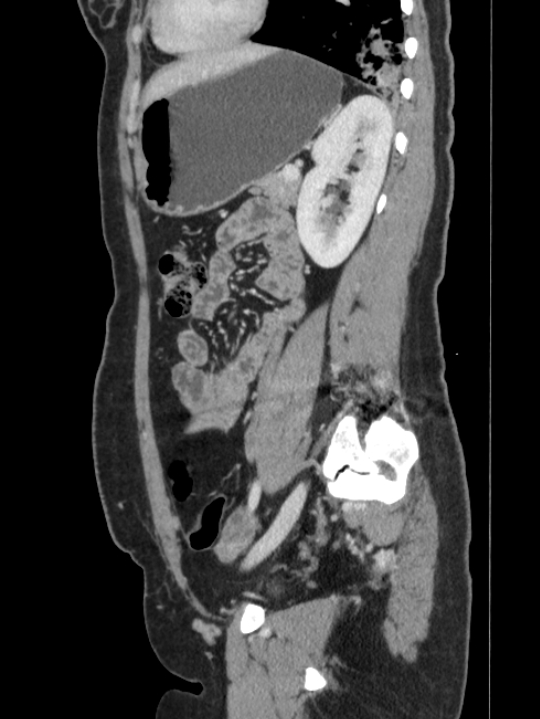 Pulmonary sequestration - intralobar | Image | Radiopaedia.org