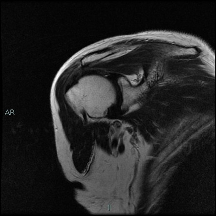 Intramuscular ganglion cyst | Image | Radiopaedia.org