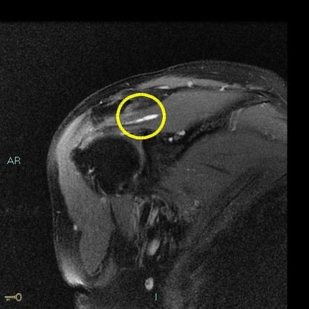 Intramuscular ganglion cyst | Image | Radiopaedia.org