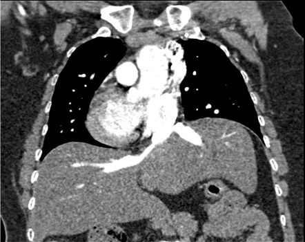 Polysplenia syndrome | Image | Radiopaedia.org