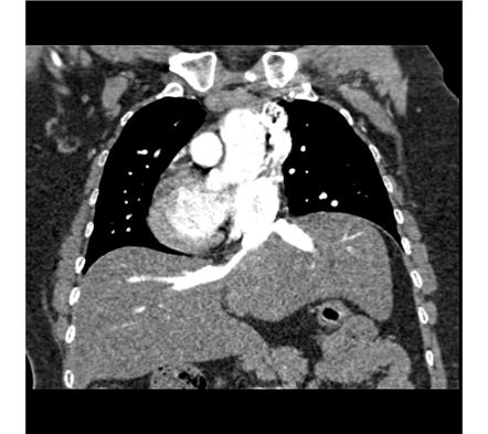 Polysplenia syndrome | Image | Radiopaedia.org