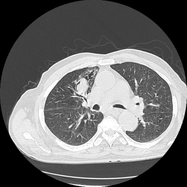 Aspergilloma | Image | Radiopaedia.org