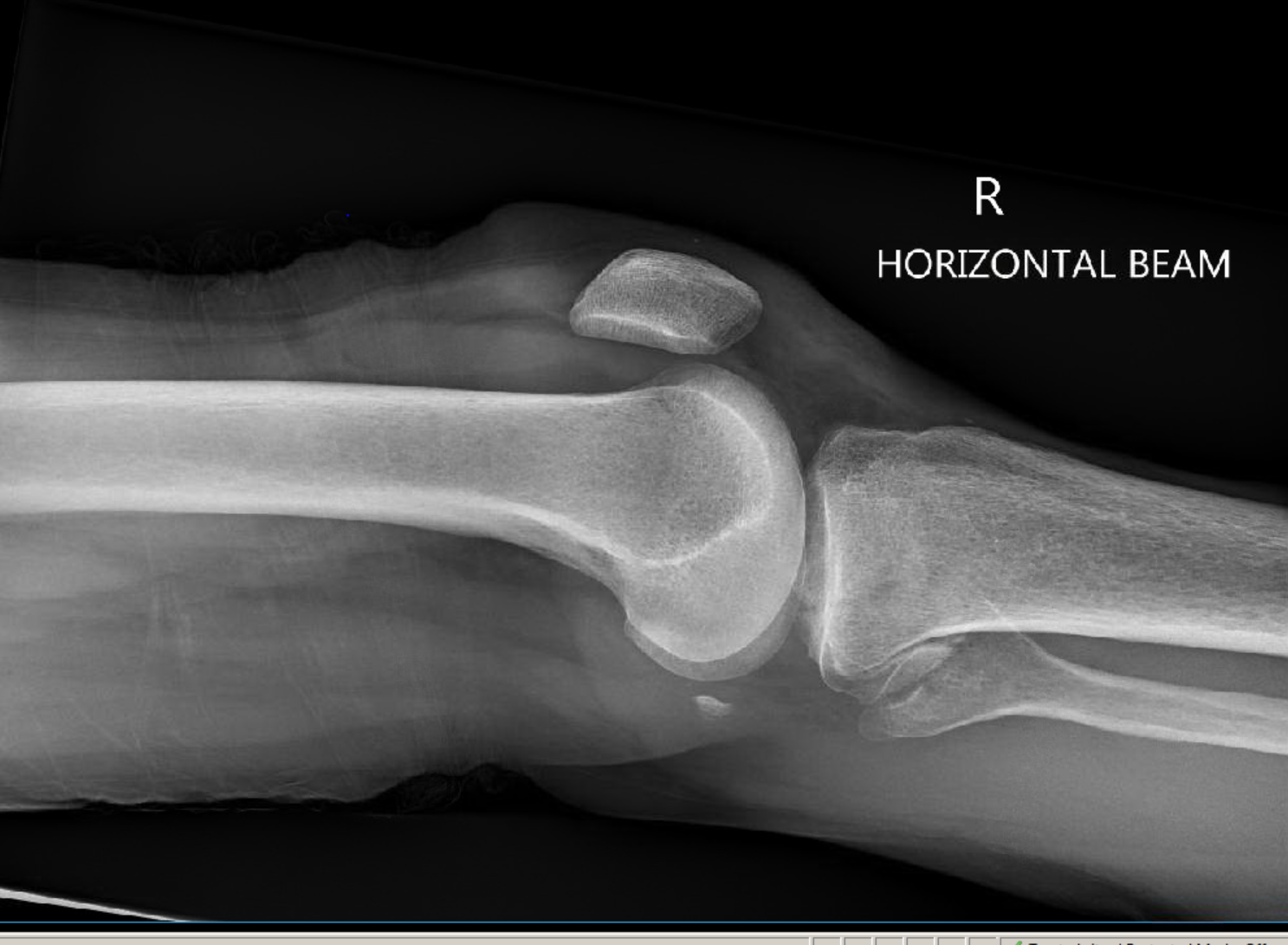 Tibial Plateau Fracture Image