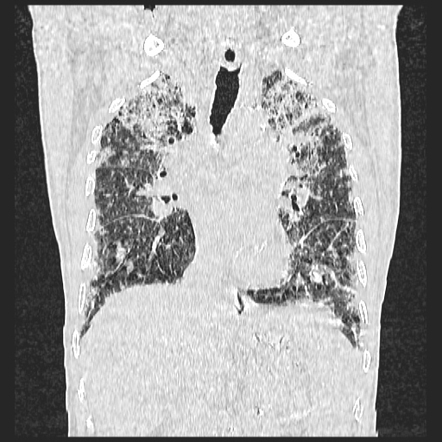 Acute Hypersensitivity Pneumonitis