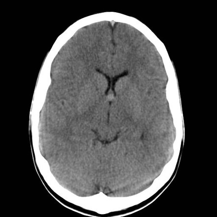 Colloid cyst of third ventricle | Radiology Case | Radiopaedia.org