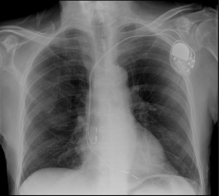 Companion shadow - right clavicle and scapula | Radiology Case ...