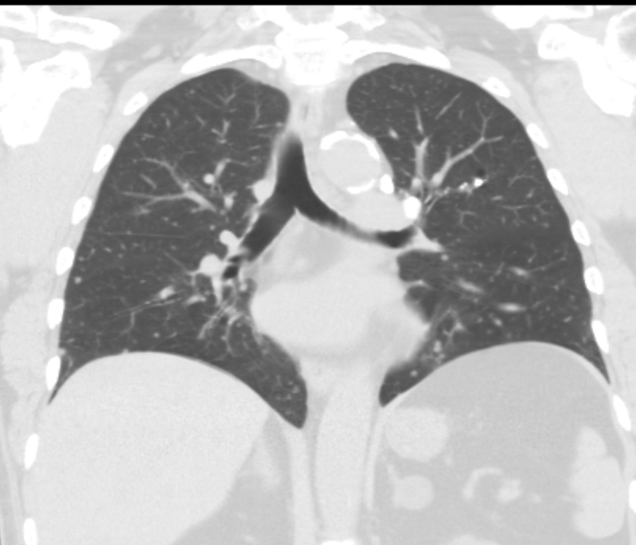 Metastatic Papillary Thyroid Cancer Image