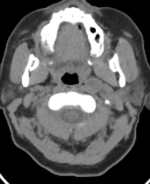 Metastatic Papillary Thyroid Cancer Image