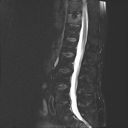 Schmorl node | Image | Radiopaedia.org