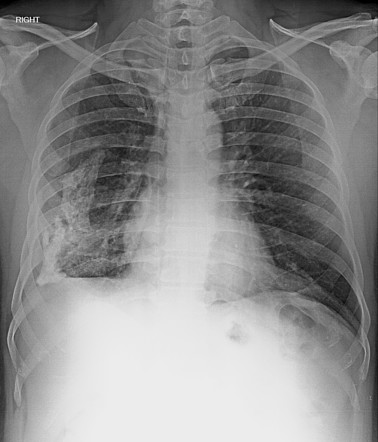 Pleural calcification | Radiology Case | Radiopaedia.org