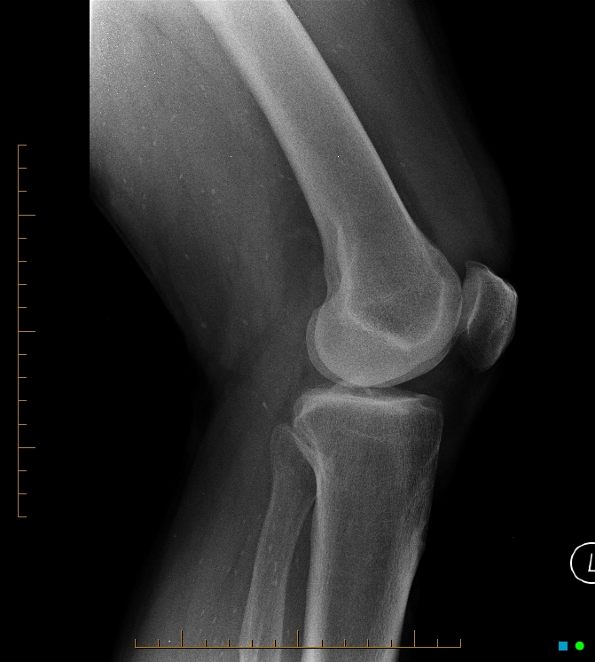 Rice grain calcification - cysticercosis | Image | Radiopaedia.org