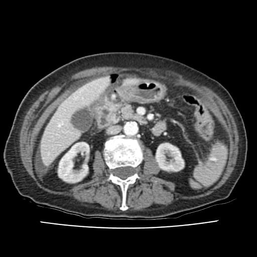 Perforated gastric ulcer | Image | Radiopaedia.org