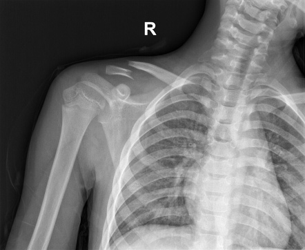 Clavicle fracture | Radiology Case | Radiopaedia.org