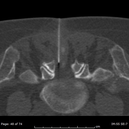 Lumbar Translaminar Epidural Injection | Radiology Case | Radiopaedia.org