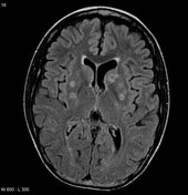 toxoplasma gondii brain abscess