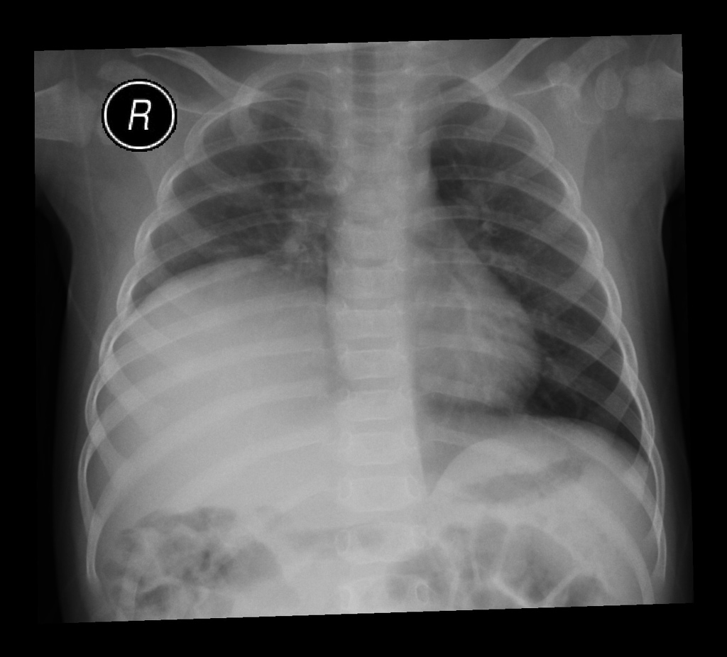 What Is The Meaning Of Elevated Right Hemidiaphragm