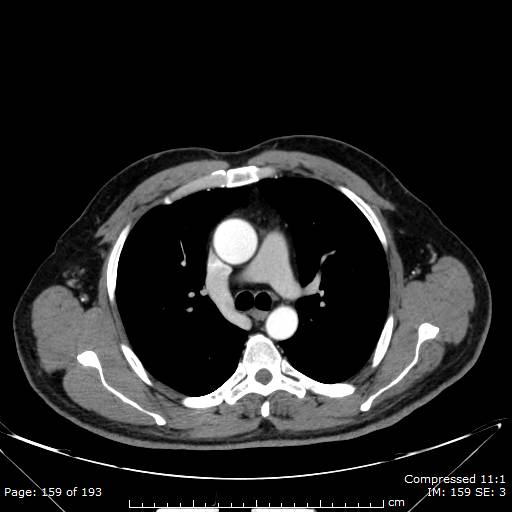 Interrupted inferior vena cava with azygos continuation | Image ...