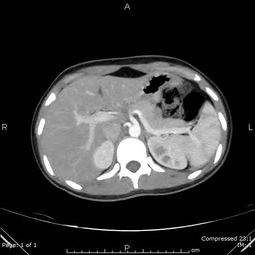 Pulmonary sequestration (intralobar) | Image | Radiopaedia.org