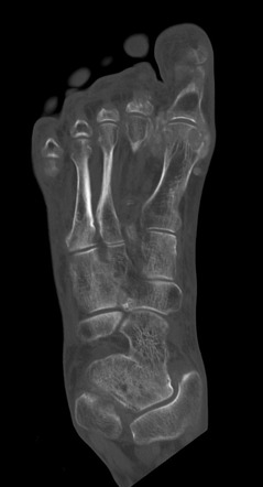 Tophaceous Gout Radiology Case Radiopaedia Org