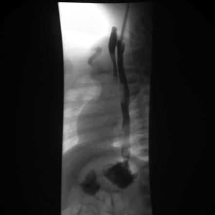 Congenital Tracheo Esophageal Fistula Radiology Reference Article Radiopaedia Org