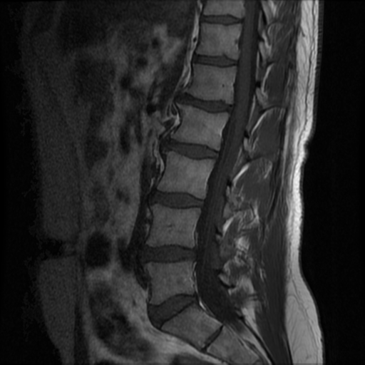 Spinal arteriovenous fistula | Image | Radiopaedia.org