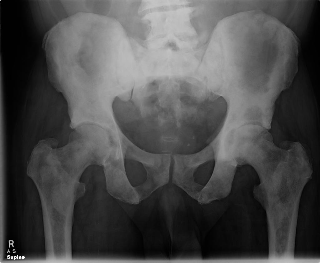 Prostate Cancer With Bone Metastases Radiology Case Radiopaedia Org