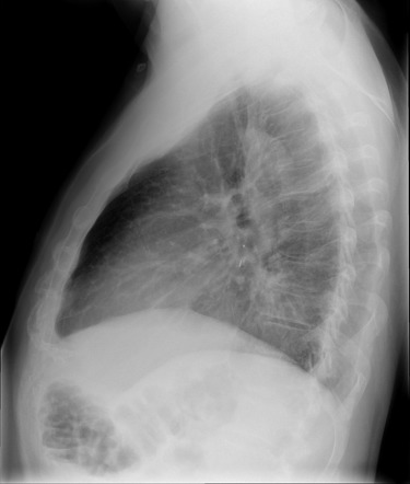 Ivor Lewis procedure | Image | Radiopaedia.org