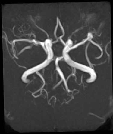 Left middle cerebral artery aneurysm | Radiology Case | Radiopaedia.org