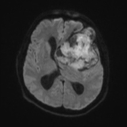 Epidermoid cyst with dystrophic calcification | Image | Radiopaedia.org