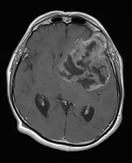 Epidermoid cyst with dystrophic calcification | Image | Radiopaedia.org