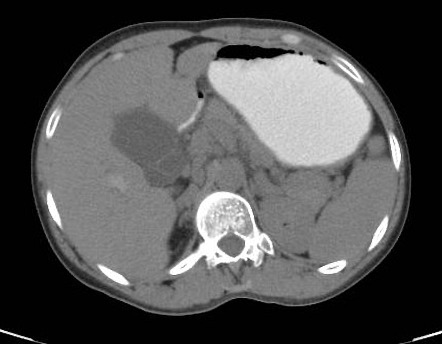 Primary Sclerosing Cholangitis | Radiology Case | Radiopaedia.org