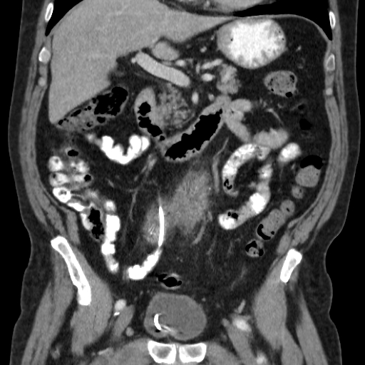 Retroperitoneal fibrosis | Image | Radiopaedia.org