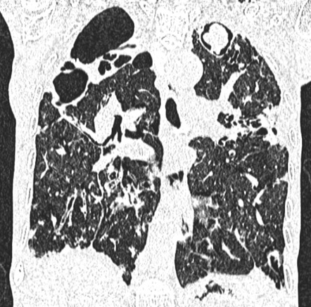 Aspergilloma: With Monod Sign | Radiology Case | Radiopaedia.org