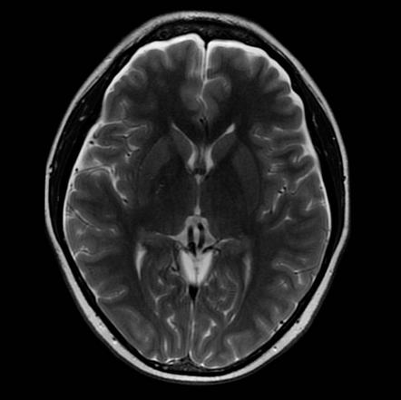 Intracranial hypotension | Radiology Case | Radiopaedia.org